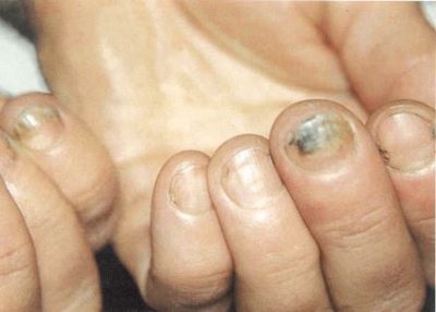 hámlasztó köröm kezelés gomba a kézen nail gombusz a lábakon modern kezelés