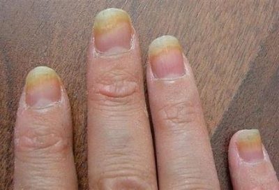gomba a körmök kezeléseken nail fungus fertőtlenítő ház