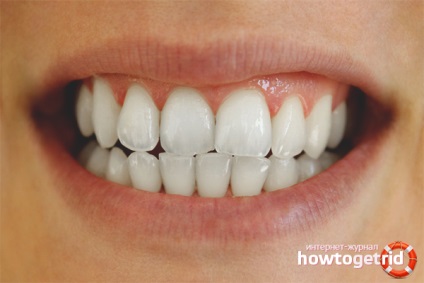 Hogyan fehéríti a fogakat otthon szóda