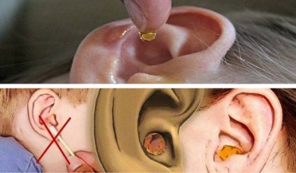 Hogyan lehet eltávolítani a kén a füle természetesen anélkül, hogy káros az egészségre