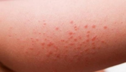 Mi dermatitis gyermekeknél (fotó)