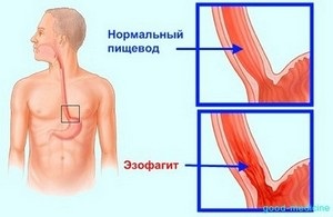 Candida oesophagitis - típusok, okok, tünetek, kezelés