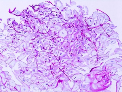 Candida oesophagitis - típusok, okok, tünetek, kezelés