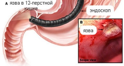 A kúra a fekély duodenum 12 az első tünet