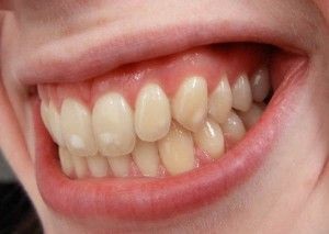 A kezelés fogászati fluorózis a gyermekek és a felnőttek (kezelés) A kezelés fogászati fluorózis gyermekeknél és felnőtteknél
