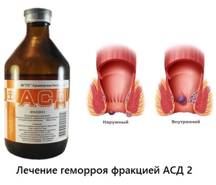 Aranyér kezelésére ASD frakció 2 - helyén a kezelések Neumyvakina orvosok Bolotov ogulova