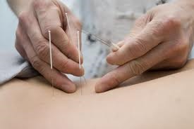 akupunktúrás kezelés
