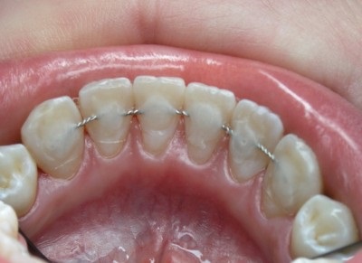 periodontális betegek kezelésére diabetes mellitus