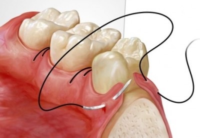 A főbb periodontális betegségek