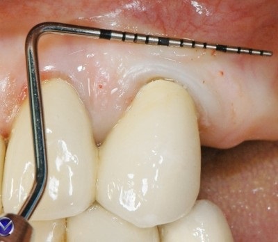 periodontális betegek kezelésére diabetes mellitus kezelése berezov debet