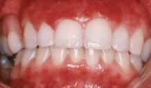 Cukorbetegség 1. típusú periodontális betegség
