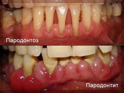 periodontális betegség a cukorbetegség kezelésére