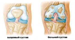 Kezelése reaktív arthritis a térdízület, mint a térd kezeljük reaktív arthritis