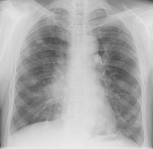 Tüdőmetasztázis- - diagnózis, tüdőmetasztázisokat fotó, áttétek a tüdőben néz ki,