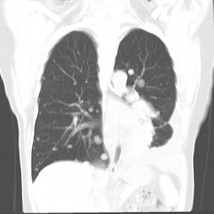 Tüdőmetasztázis- - diagnózis, tüdőmetasztázisokat fotó, áttétek a tüdőben néz ki,