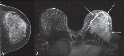 Mell MRI, amely megmutatja, fotók, árak, foglalás