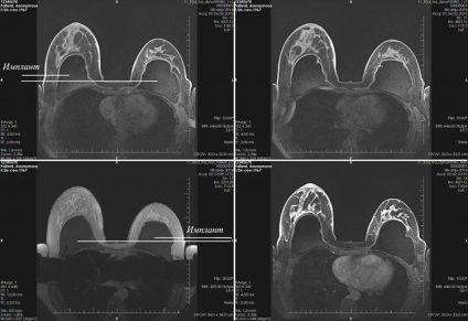 Mell MRI - javallatok és ellenjavallatok