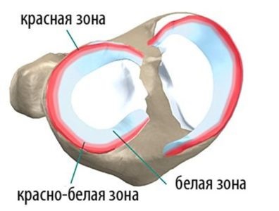 Műtét a térd meniscus műtét utáni rehabilitáció