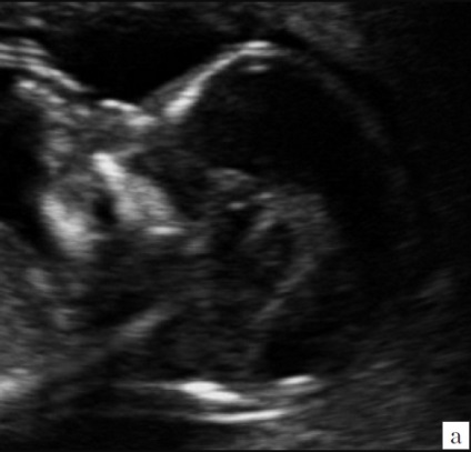Octopussy - új funkció az ultrahangos értékelés középvonali struktúrák magzati agy 11-14 (ultrahang) Octopussy - jele egy új ultrahang vizsgálat a középvonal struktúrák az agy a magzat 11-14