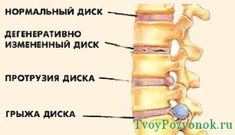 Osteochondrosis a nyaki gerinc és a lemez kiemelkedés, a kezelés a nyaki gerinc