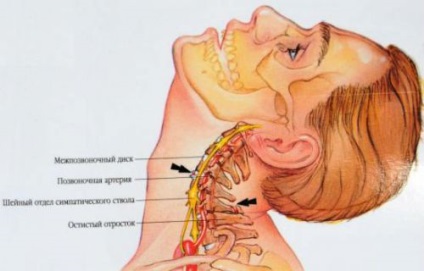 Tövisnyúlványtól a gerinc és a csigolyatörés (cervikális stb