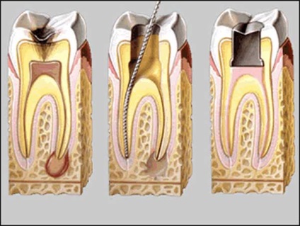 Akut periodontitis - tünetei, differenciál diagnózis és a kezelés