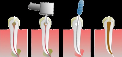 Akut periodontitis - tünetei, differenciál diagnózis és a kezelés