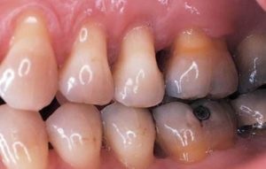 Akut savós periodontitis tünetei és kezelése