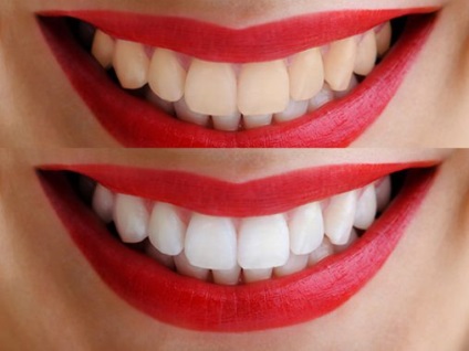 Fogfehérítés csodálatos fehér fogak előnyei és hátrányai