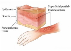 Burn - kezelés, fokú, elsősegély