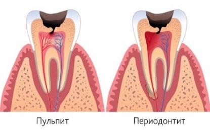 A periodontitis tünetei, a kezelés