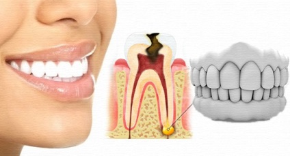 A periodontitis tünetei, a kezelés