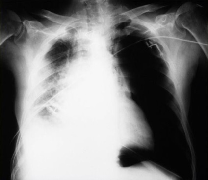 Pneumothorax tüdő okoz, tünetek és kezelés