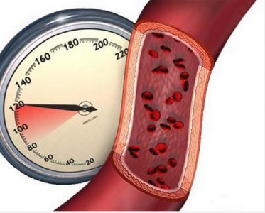 Miért vérnyomás emelkedik éjjel mögöttes okok és a kezelés