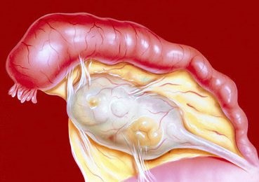 A következmények gonorrhea a nők és a veszélyes szövődmények (gonorrhoea) A következmények gonorrhea a nők és a veszélyes szövődmények