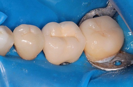 Az ortopéd hátsó fogak (kompromisszum) - Ortopédia - hírek és cikkek