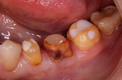 Az ortopéd hátsó fogak (kompromisszum) - Ortopédia - hírek és cikkek