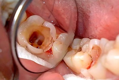 kezelésére fogbél ár depulpation hogyan kezelje tejtermékek, a maradandó fogak