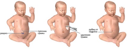 Köldöksérv csecsemők okai és kezelése