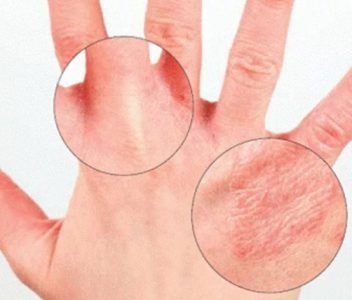 Bőrirritáció okozza és a kezelés a kéz