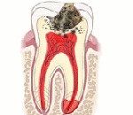 Savós periodontitis - okai, tünetei, diagnózis és kezelés (savós) Savós Periodontitiszt - okai, tünetei, diagnózisa és kezelése