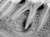 Savós periodontitis - okai, tünetei, diagnózis és kezelés (savós) Savós Periodontitiszt - okai, tünetei, diagnózisa és kezelése