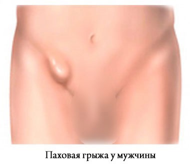 Tünetei lágyéksérv helyreállítsa a jellegzetes tünetek (tünetek) Tünetei lágyéksérv javítás minden jellemzőjével