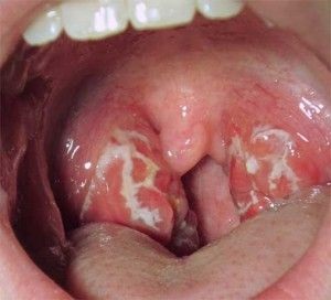 Stomatitis gombás kezelés gyermekeknél és felnőtteknél