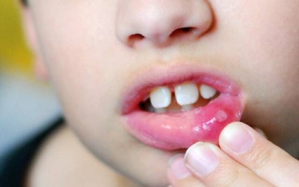 Fekély, seb a száj kezelések otthon