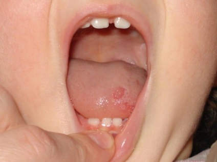 A szájüregi daganatok korai tünetei - Férgek és sebek a nyelven