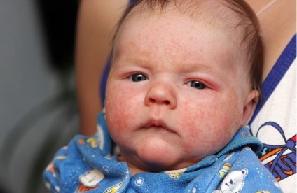 Mérgező bőrpír az újszülött okai és kezelése
