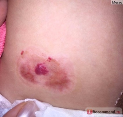 Eltávolítása hemangiomas krioterápia (folyékony nitrogénnel) - „én beszélni, hogy mit kell tenni, ha a gyermek (do) Eltávolítása hemangiomas krioterápia (folyékony nitrogénnel) - „beszélni, hogy mit kell tennie, ha a gyermek