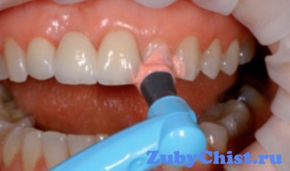 Feszesítő gél fogak fogszuvasodás és a gyerekek mit gondolnak a fogorvosok