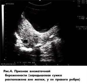 Ultrahang diagnosztika a méhen kívüli terhesség
